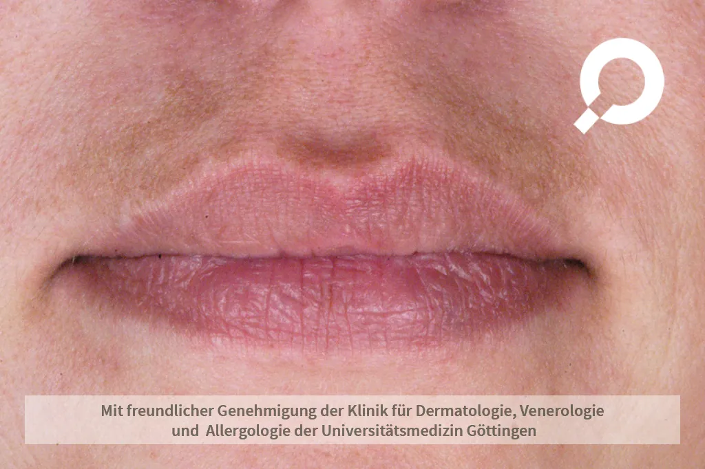 Melasma (Pigmentierung) an der Oberlippe