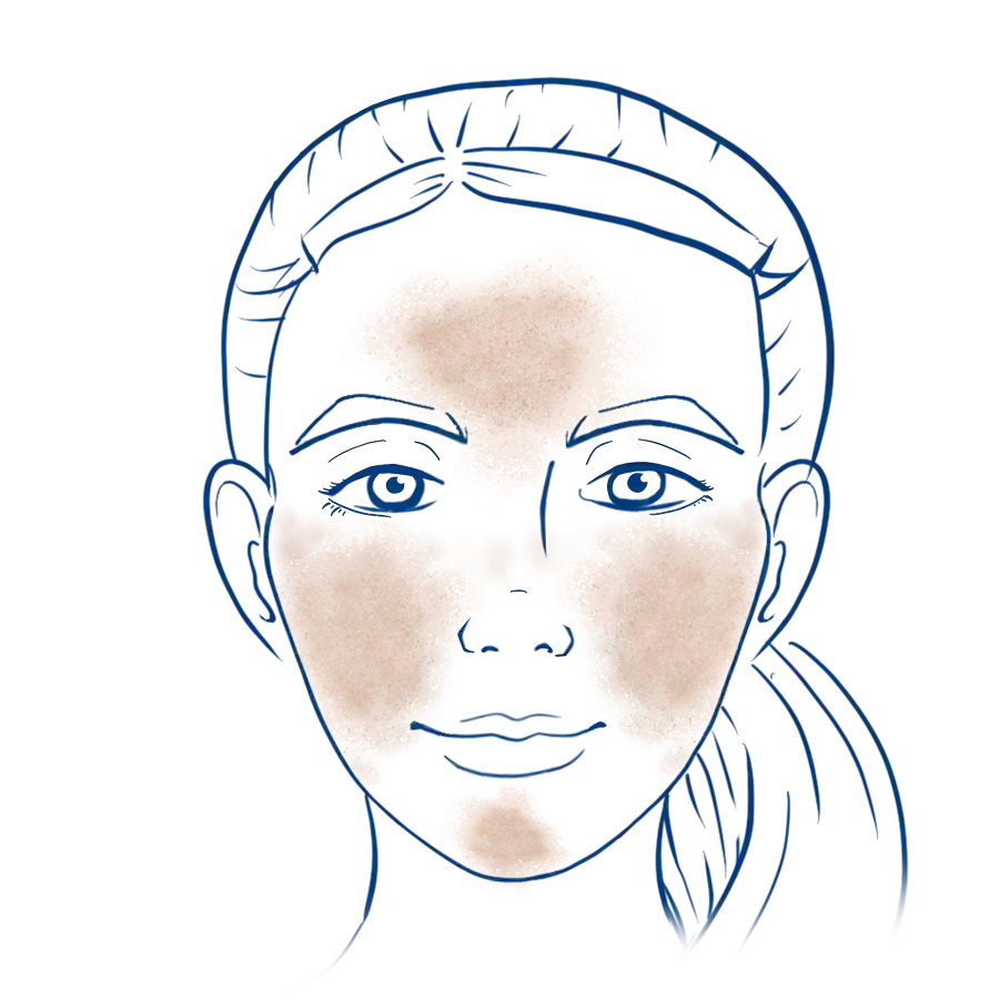 Malasma Illustration - Symptome und Lokalisation