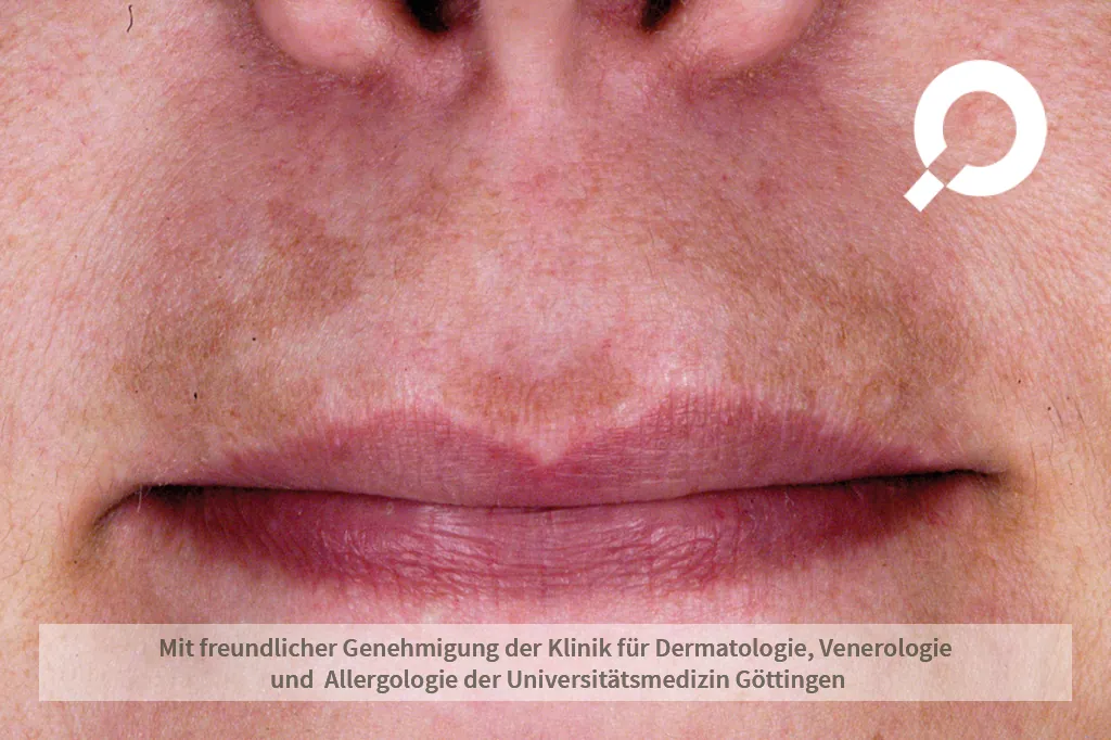 Melasma (Pigmentierung) an der Oberlippe