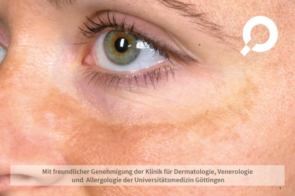 Melasma/ Pigmentierung am unteren Augenrand