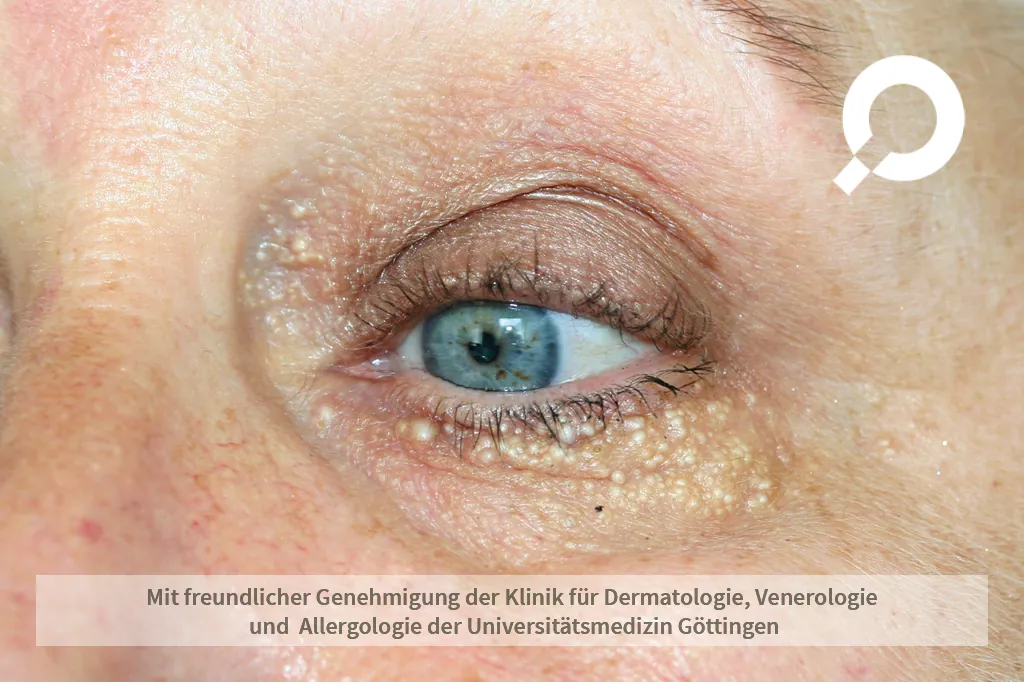 kleine weiße Punkte um das Auge