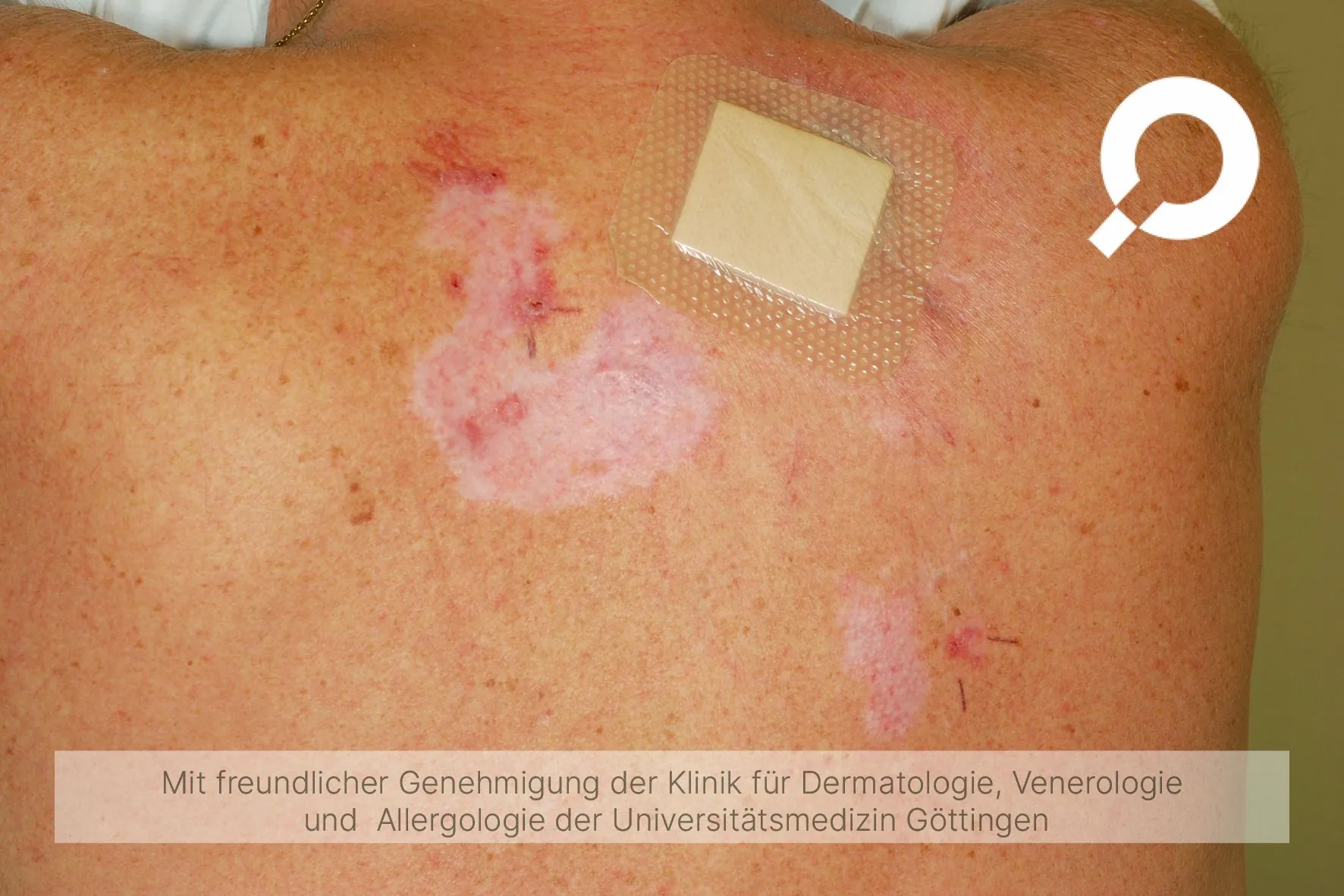 Morbus Bowen Ausschlag blutig Rücken