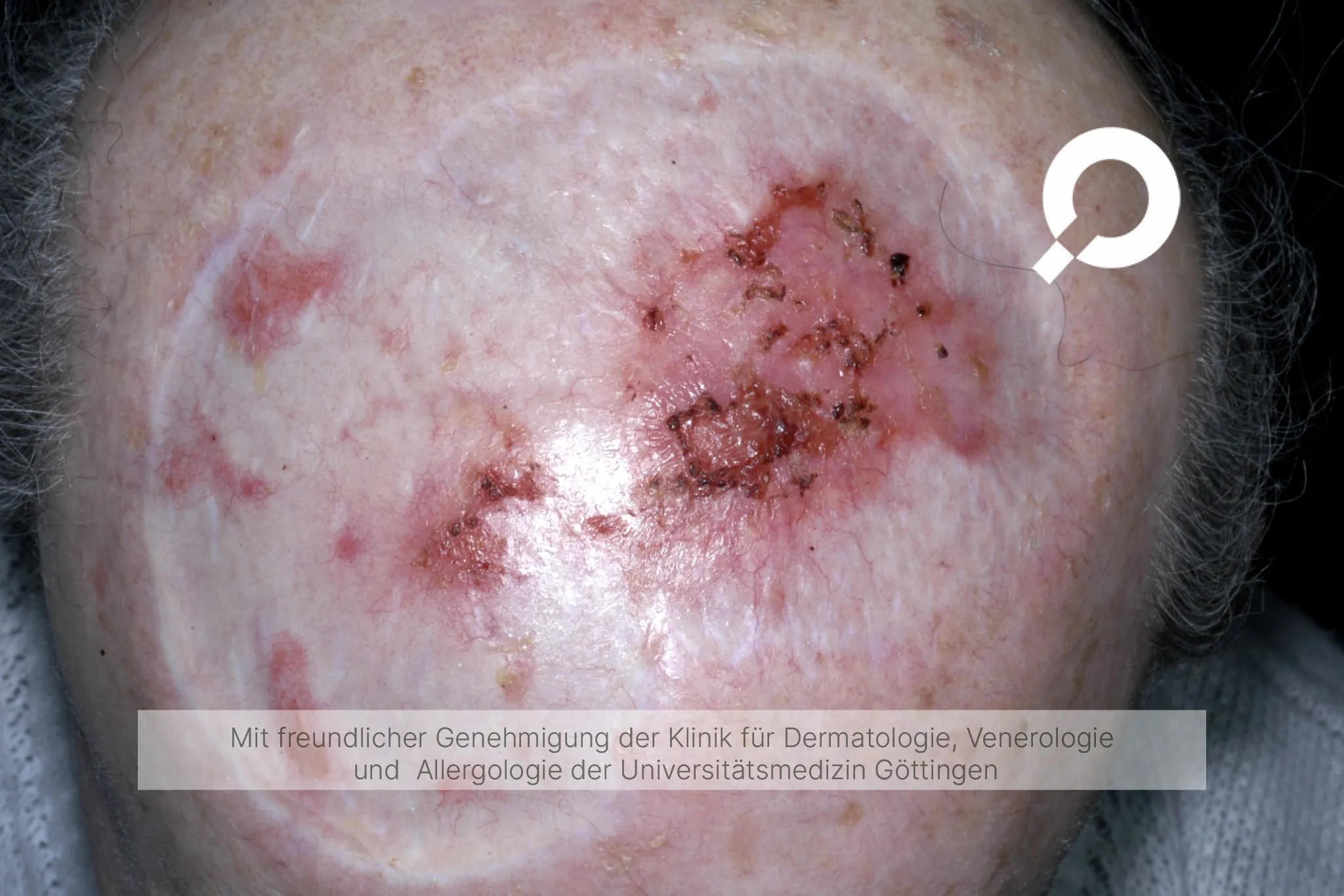 Morbus Bowen blutiger Hautschaden Kopf