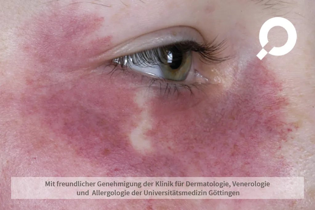 dunkelroter Fleck unter dem Auge
