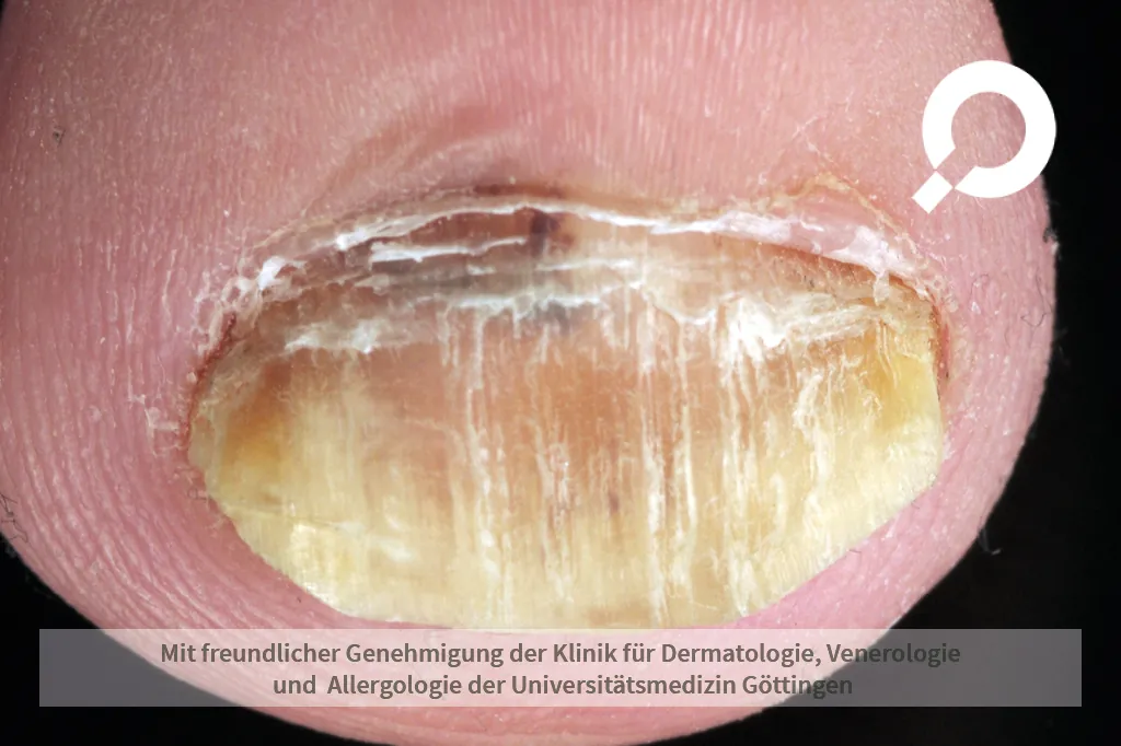 Tüpfernagel Nagelpsoriasis