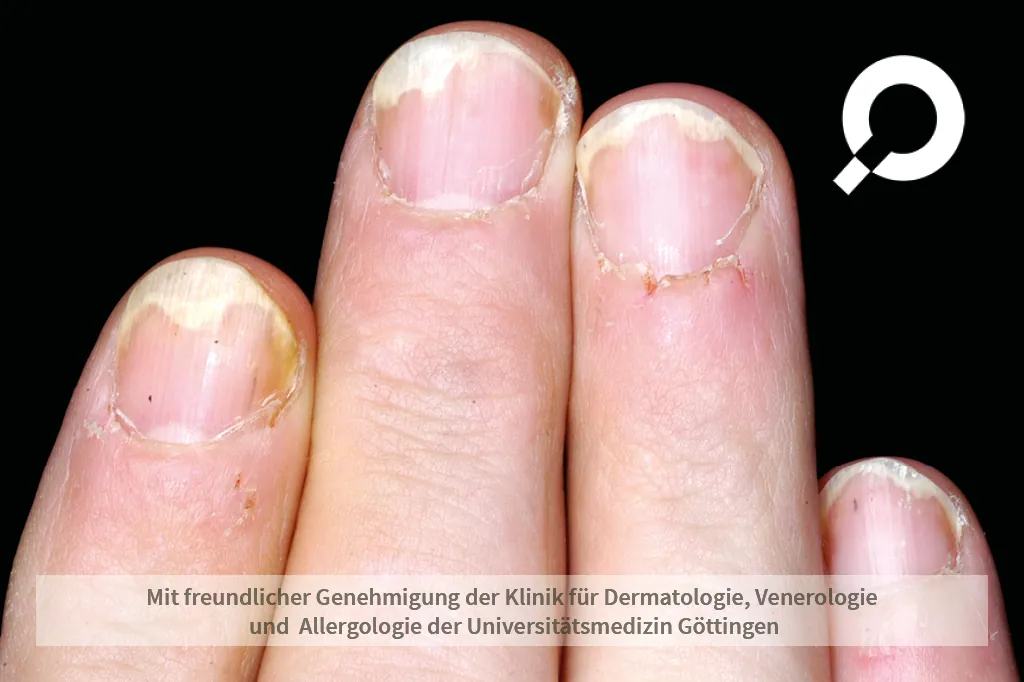 Nagelschuppen