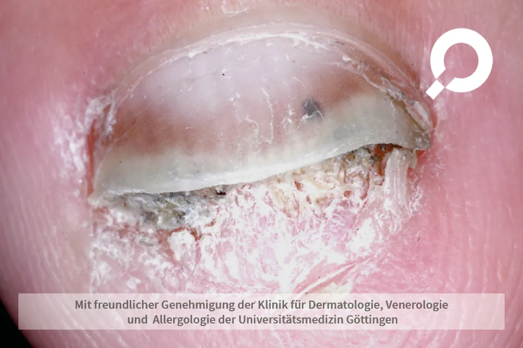 aufgelöster Fingernagel schuppig