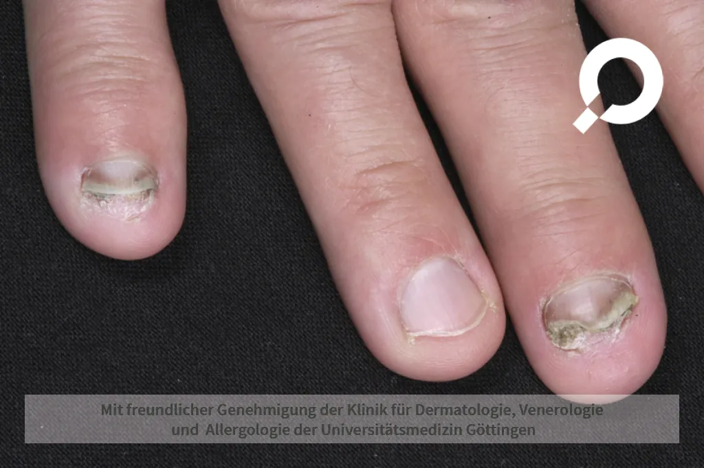 aufgelöste Fingernägel