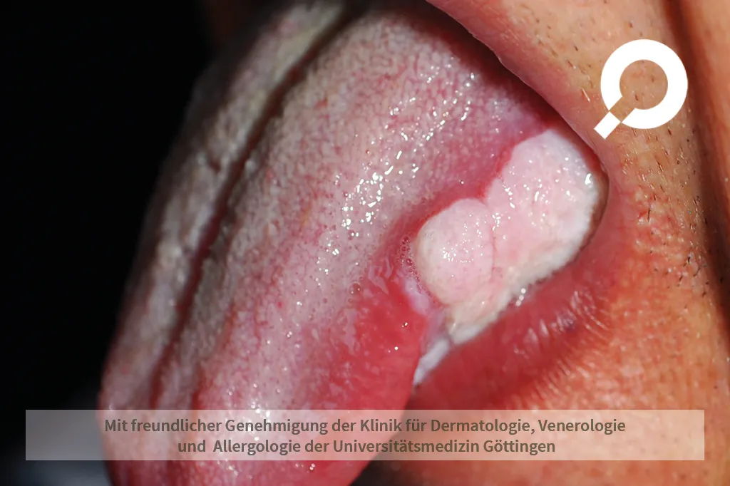 Beispielbild Symptome orale Candidose