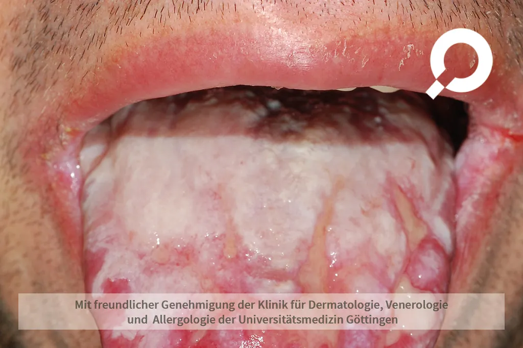 Beispielbild Symptome orale Candidose