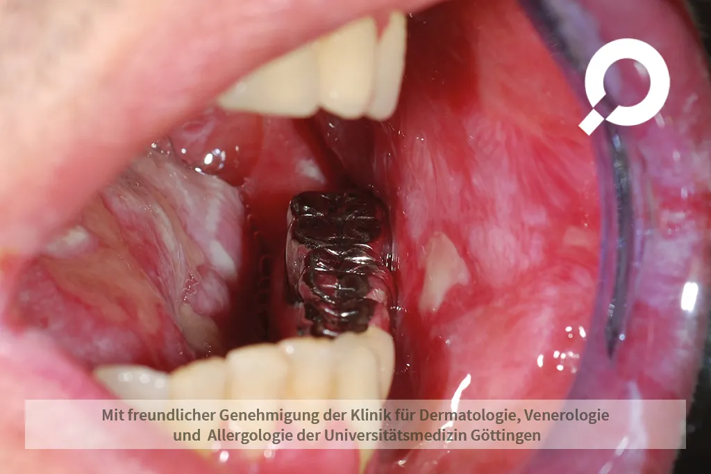 Beispielbild Symptome orale Candidose