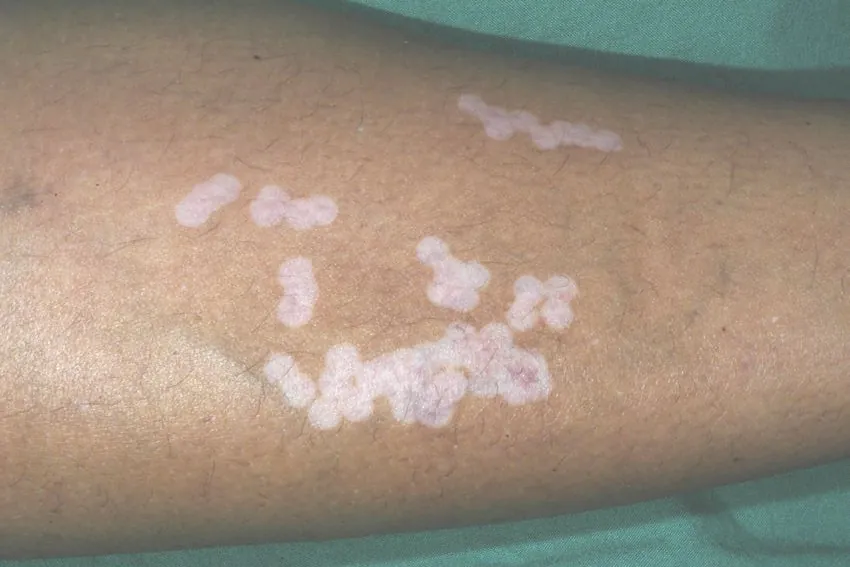 weiße Flecken Unterschenkel