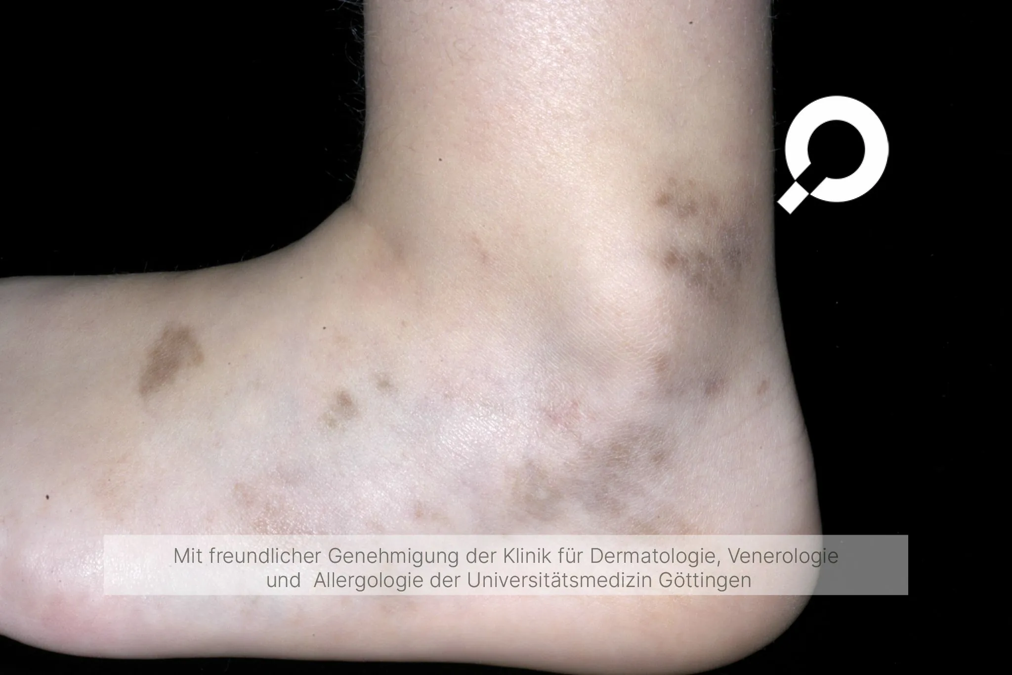 braune Pigmentflecken Fuß