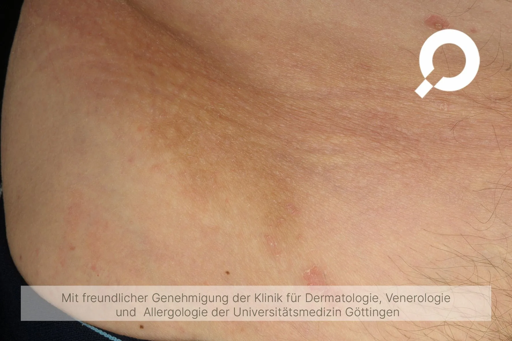 braune Pigmentflecke Nacken