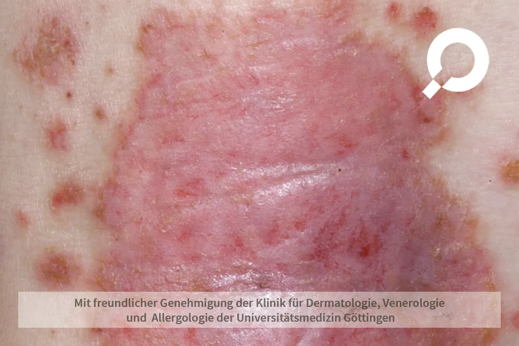 Rötungen an der Haut