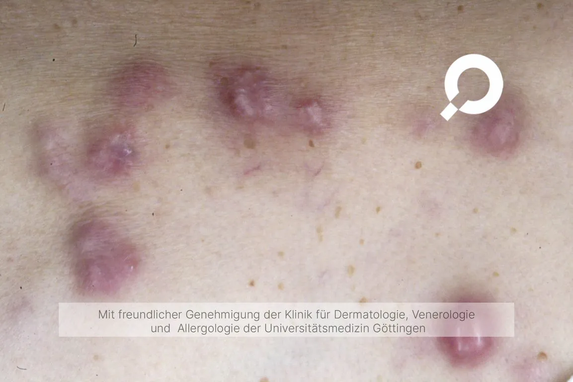 Plattenepithelkarzinom2.jpg