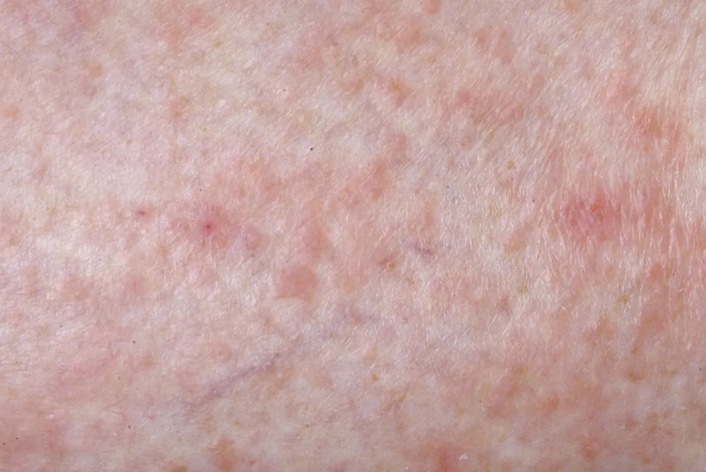 polymorphe Lichtdermatose (Sonnenallergie)