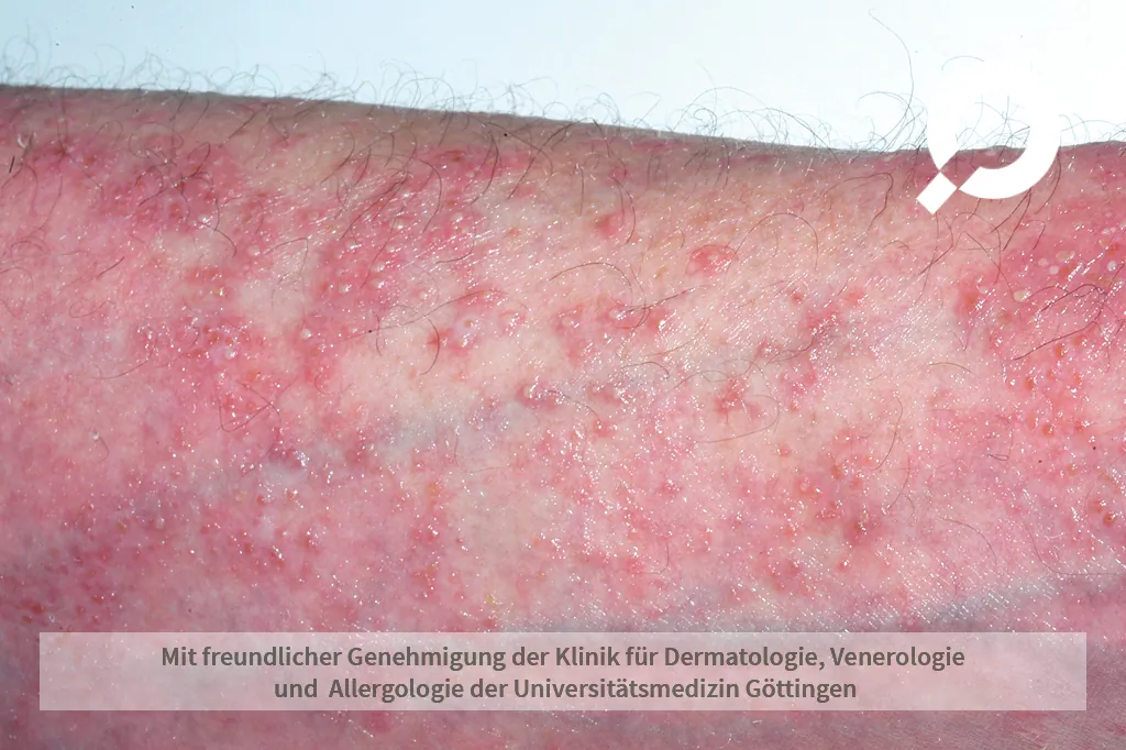 Psoriasis am Arm