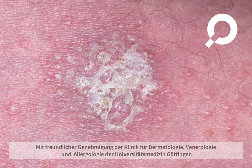 Psoriasis, Schuppenflechte