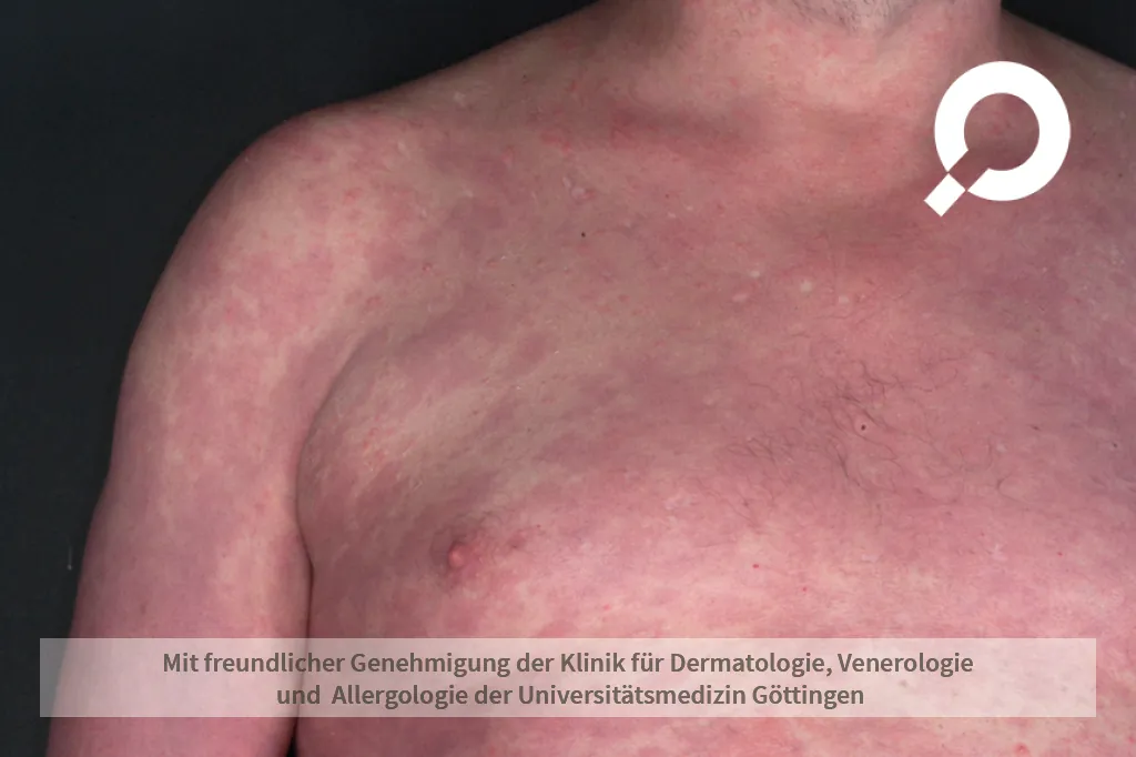 Schuppenflechte (Psoriasis) am Oberkörper