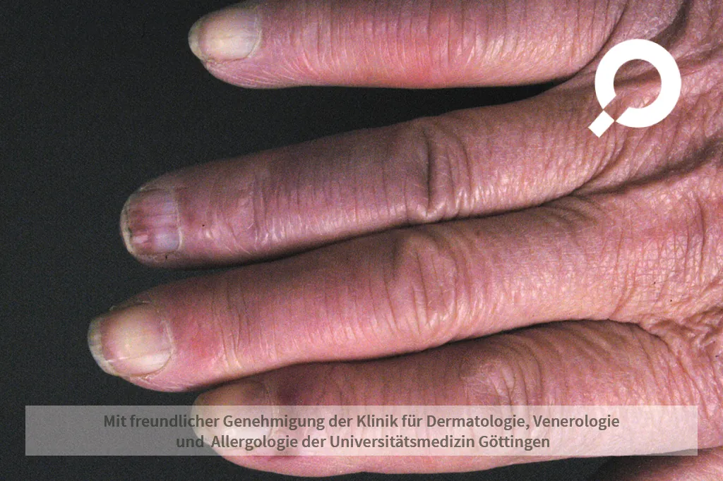 Raynaud-Syndrom an den Fingern