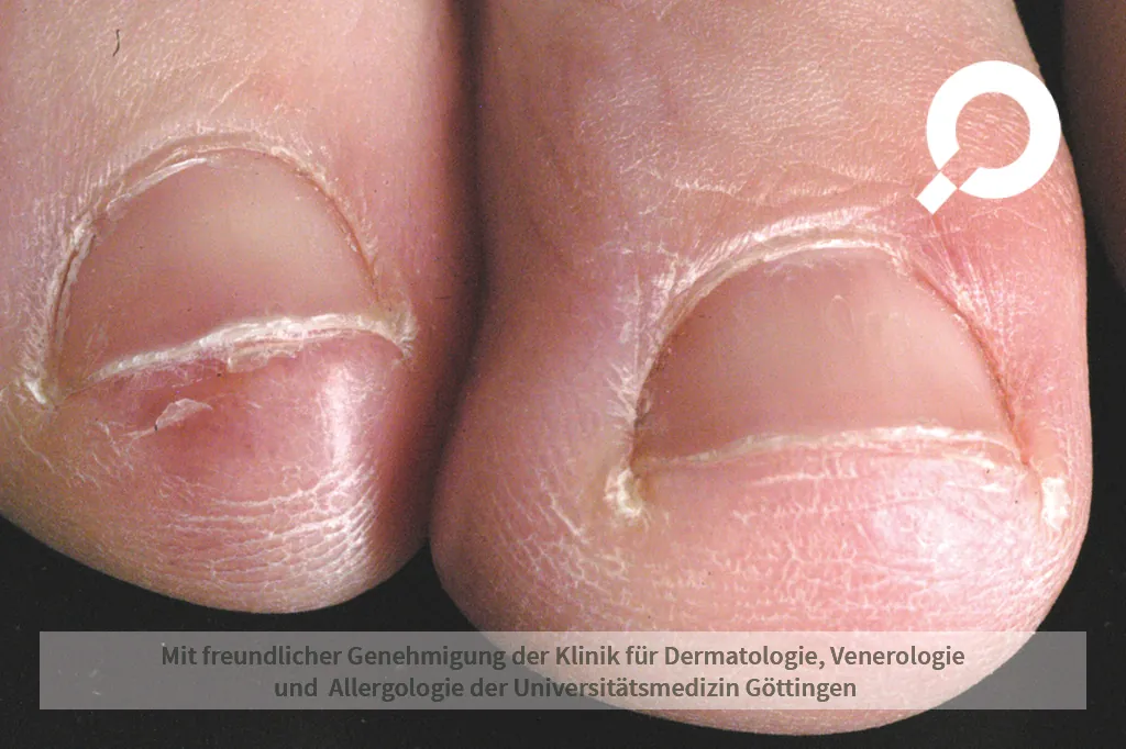 Raynaud-Syndrom am Zeh