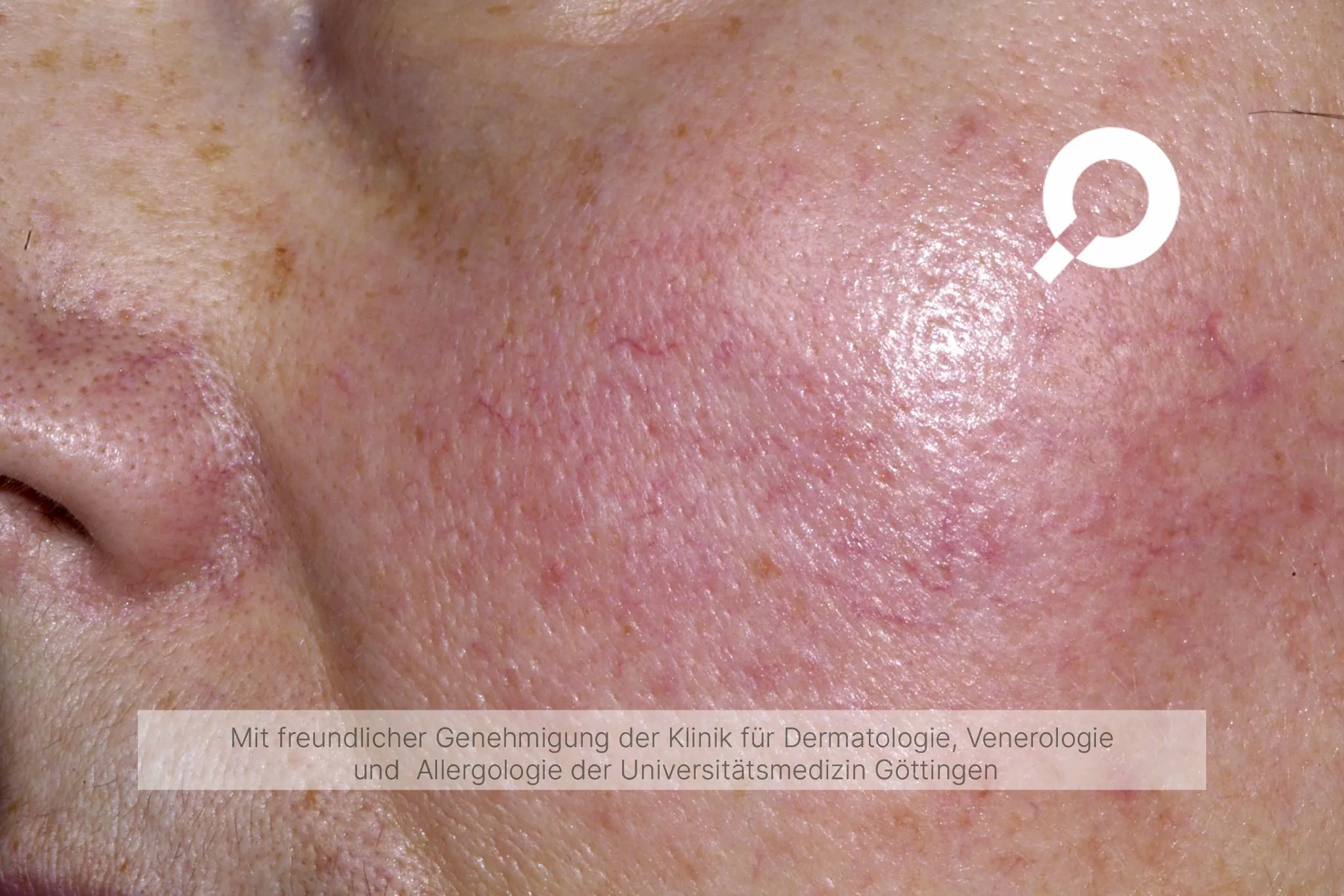 Beispielbild Symptome Rosazea