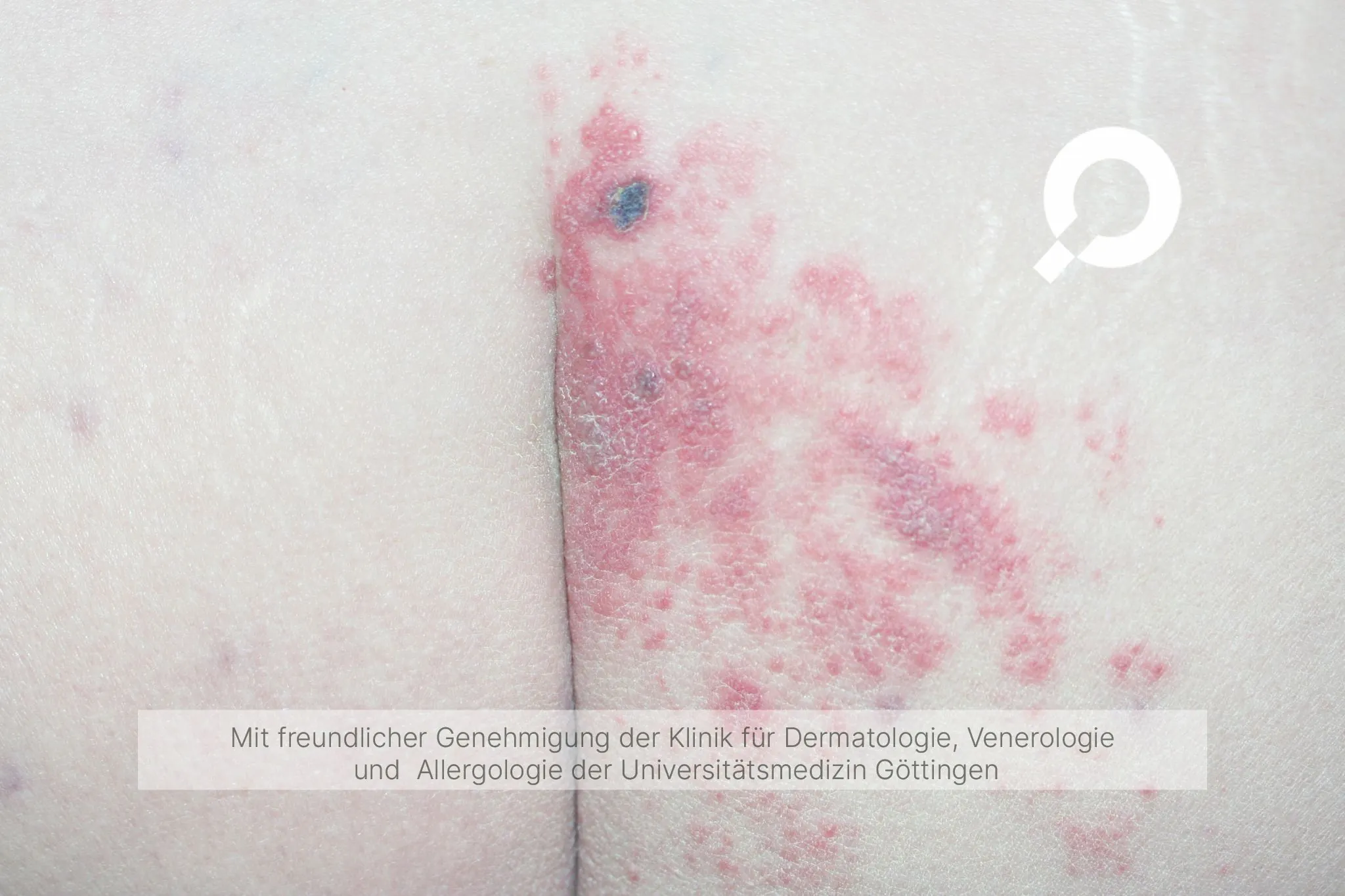 roter Ausschlag