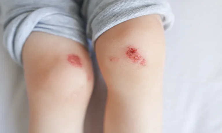 Schürfwunden