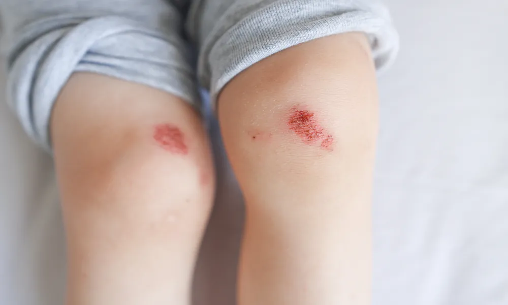 Schürfwunden