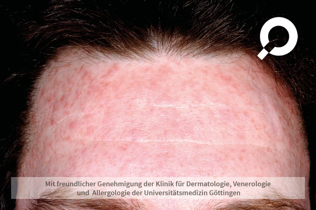 Ausschlag an der Stirn