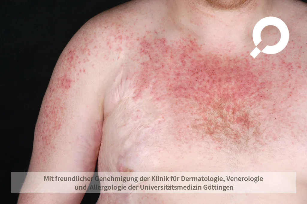 Ekzen an der Brust und Arm