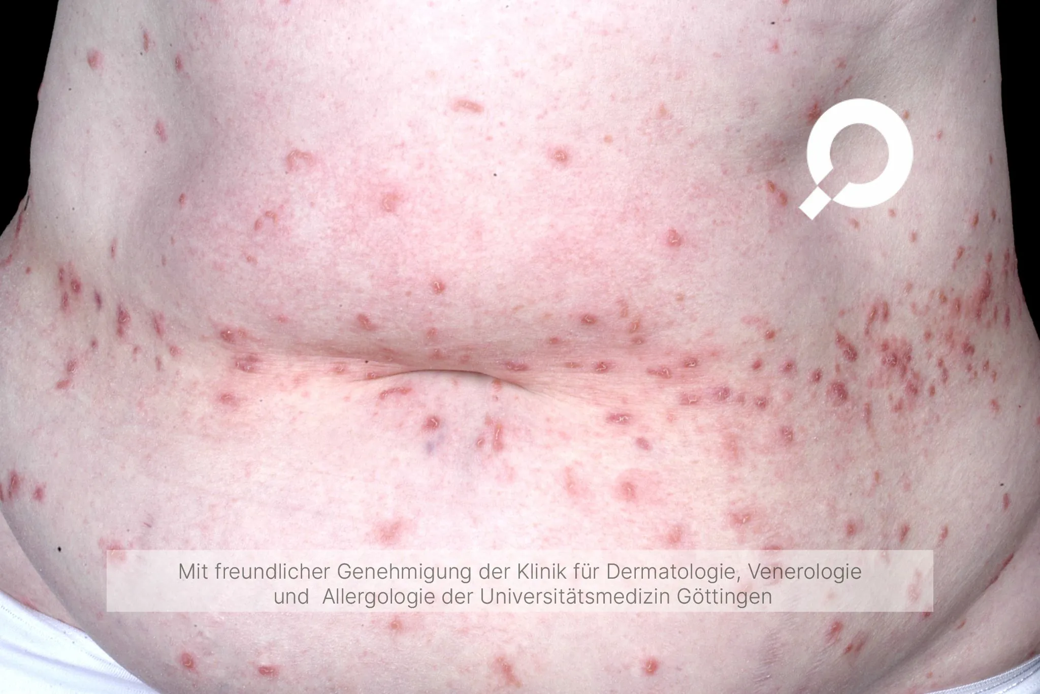 Beispielbild Symptome Skabies Krätze