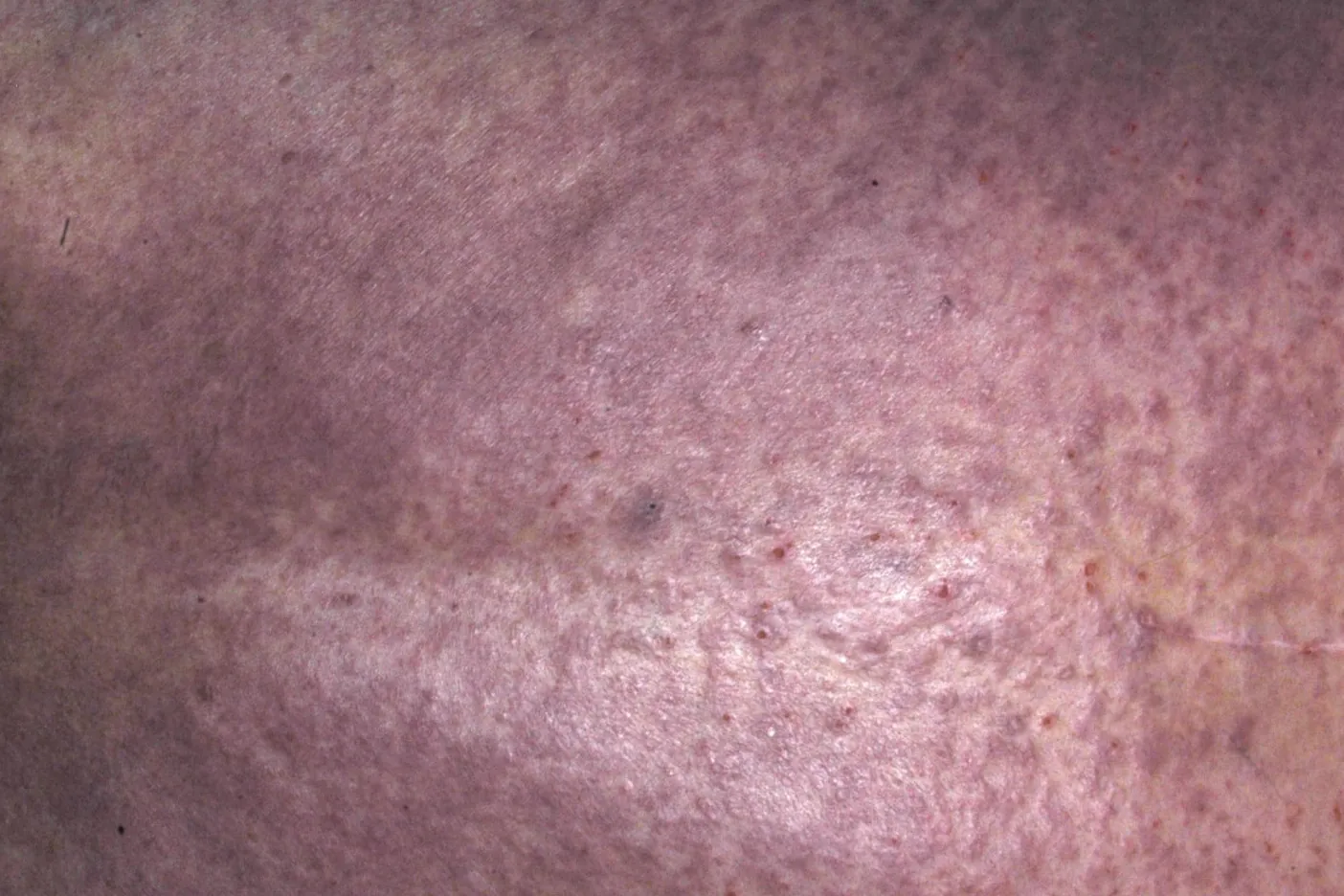 Beispielbild Symptome Skabies Krätze