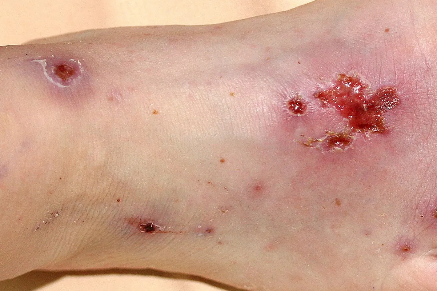 Beispielbild Symptome Skabies Krätze