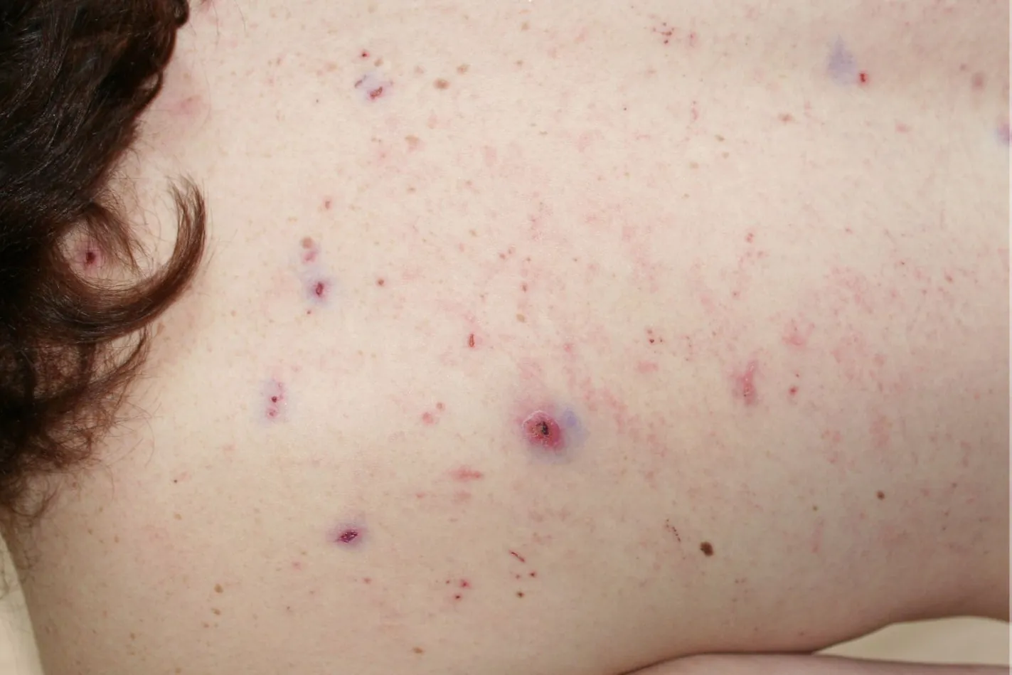 Beispielbild Symptome Skabies Krätze