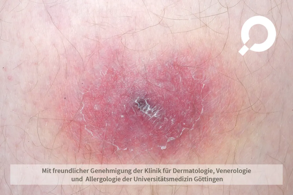 Beispielbild Symptome Spritzenabszess