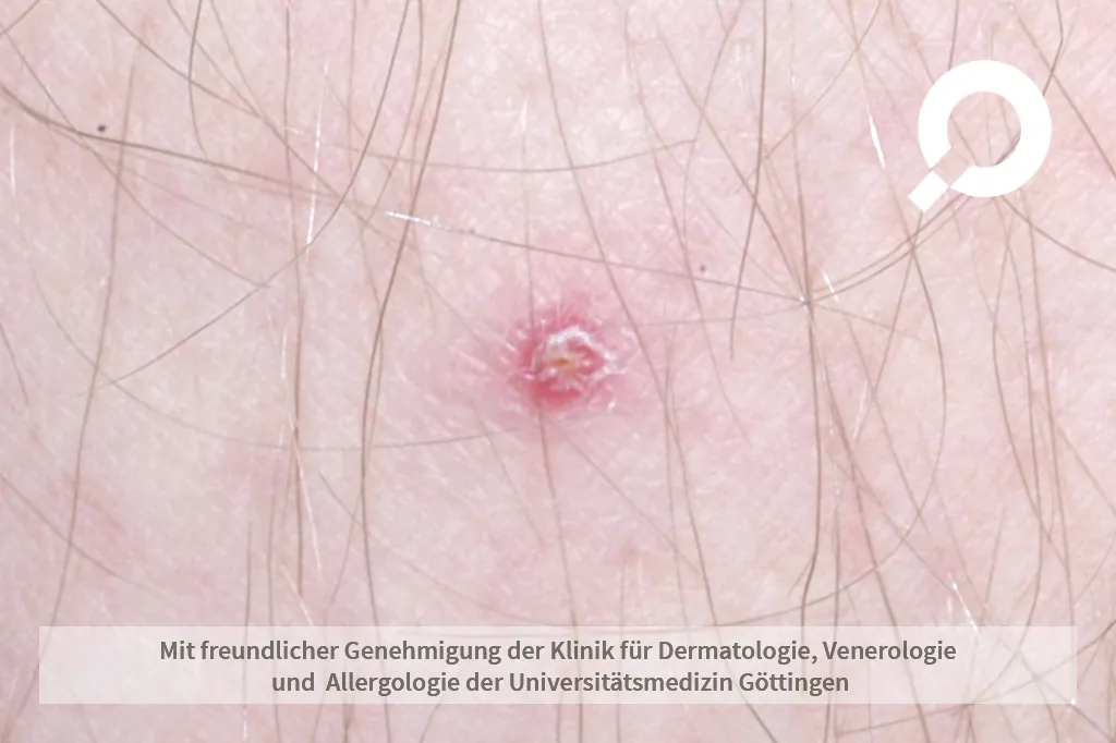 Beispielbild Symptome Spritzenabszess