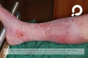 Stauungsdermatitis1.jpeg