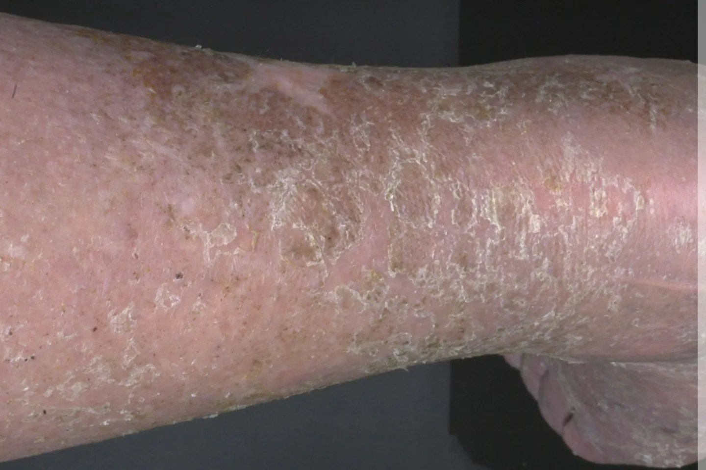 Stauungsdermatitis2.jpeg