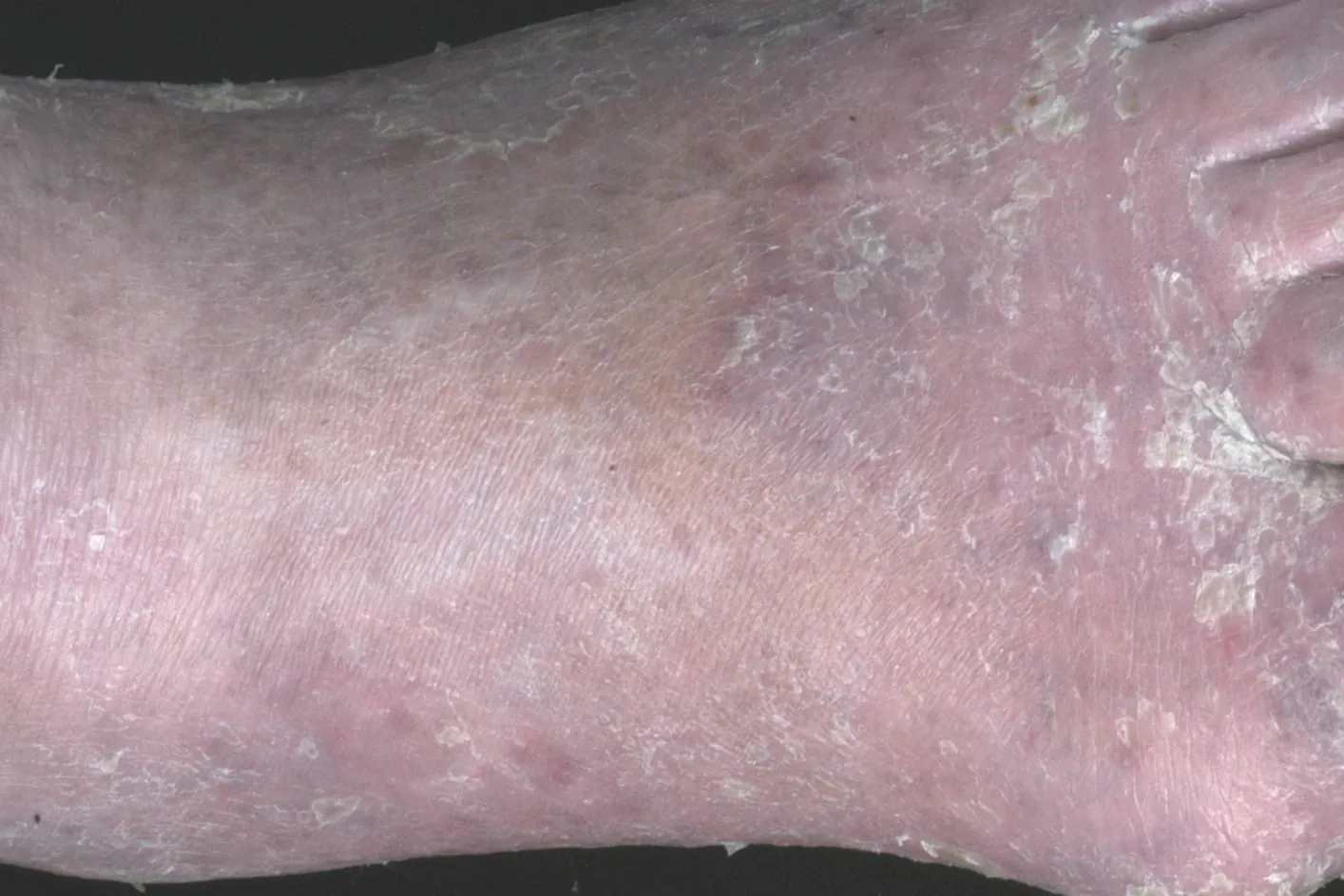 Stauungsdermatitis3.jpeg