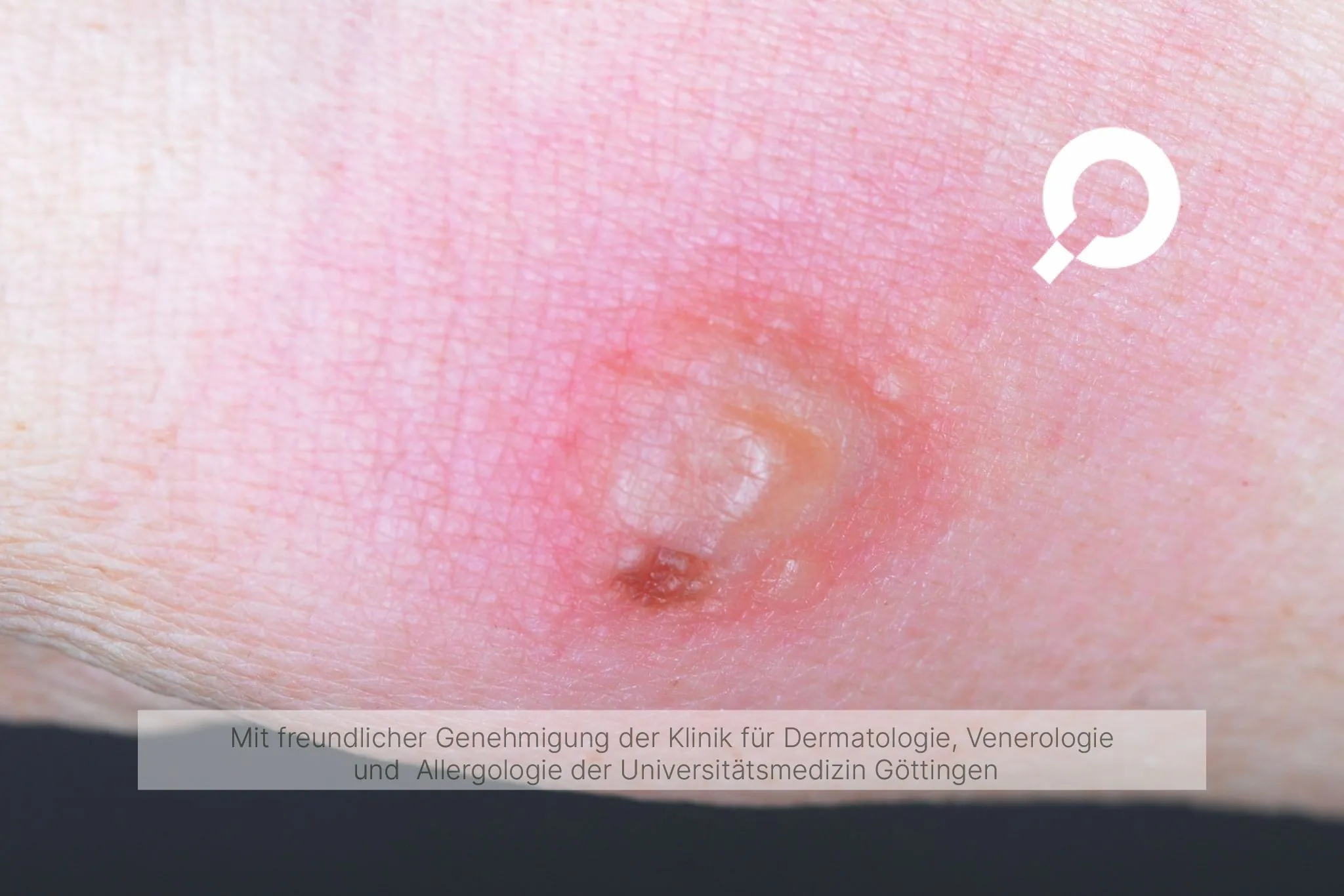 Beispielbild Symptome Sweet-Syndrom