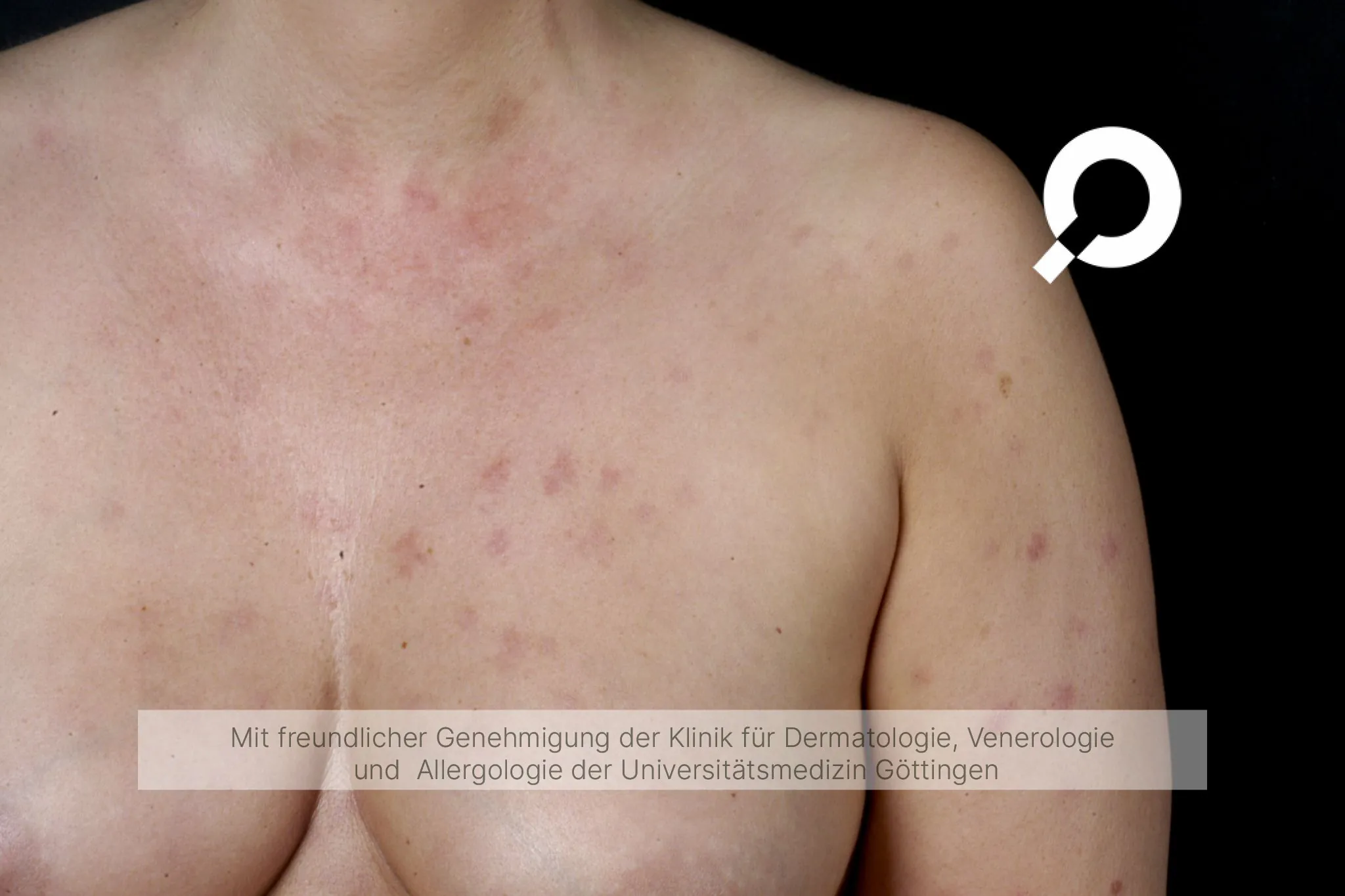 Beispielbild Symptome Sweet-Syndrom