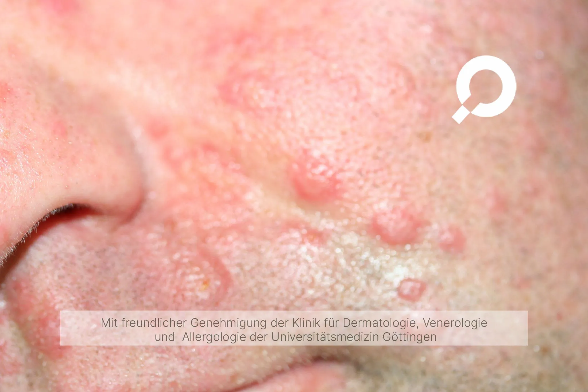 Beispielbild Symptome Sweet-Syndrom