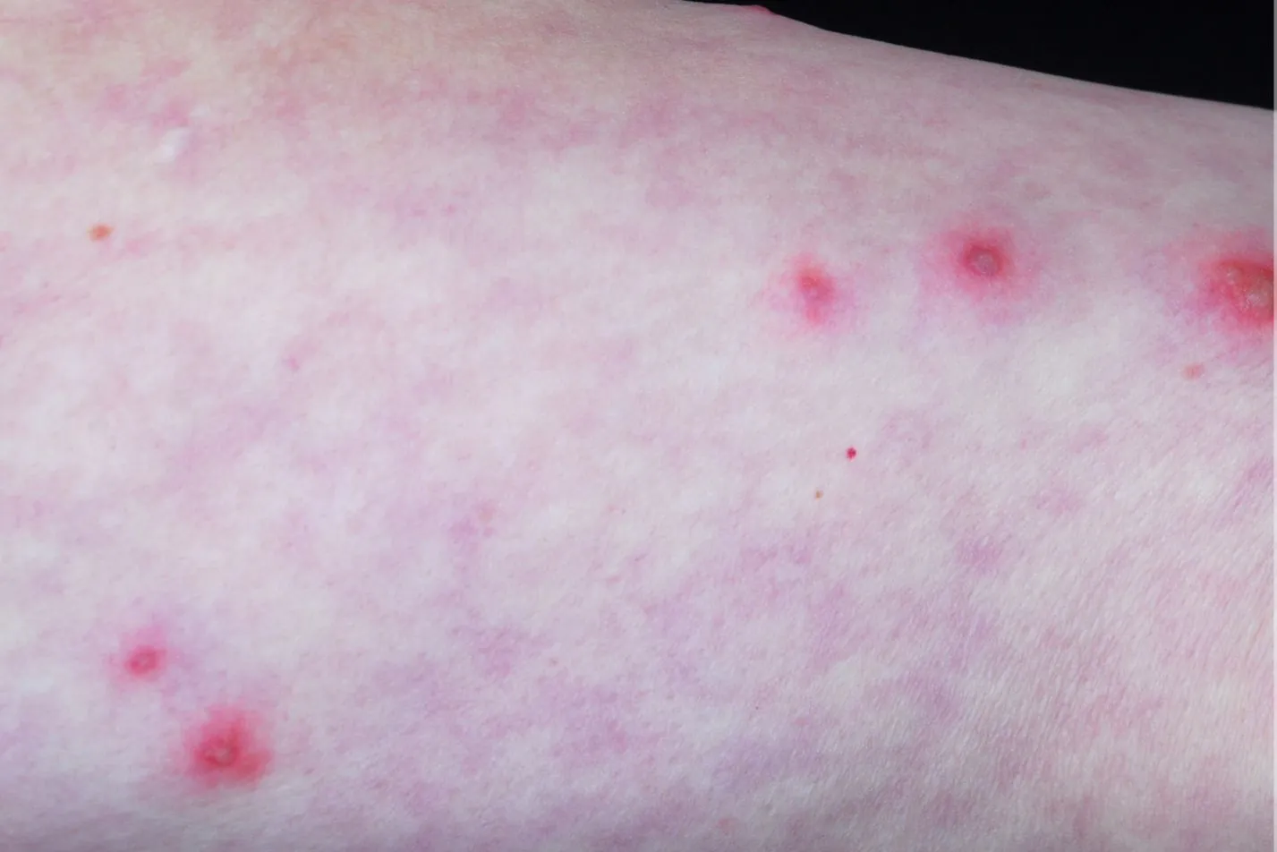 Beispielbild Symptome Sweet-Syndrom