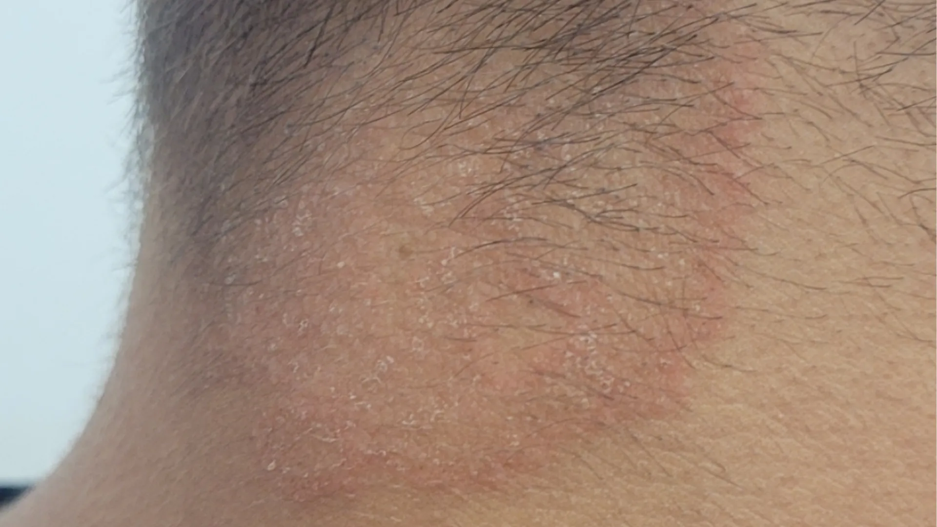 runder, roter Kreis im Nacken