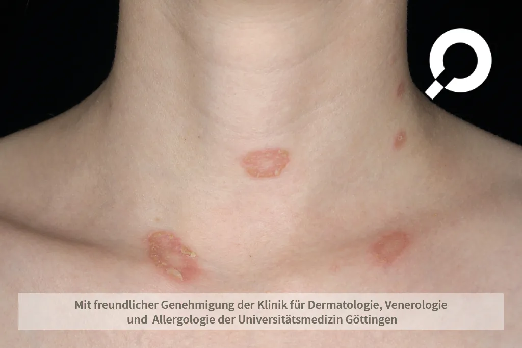 rote Flecken Nacken