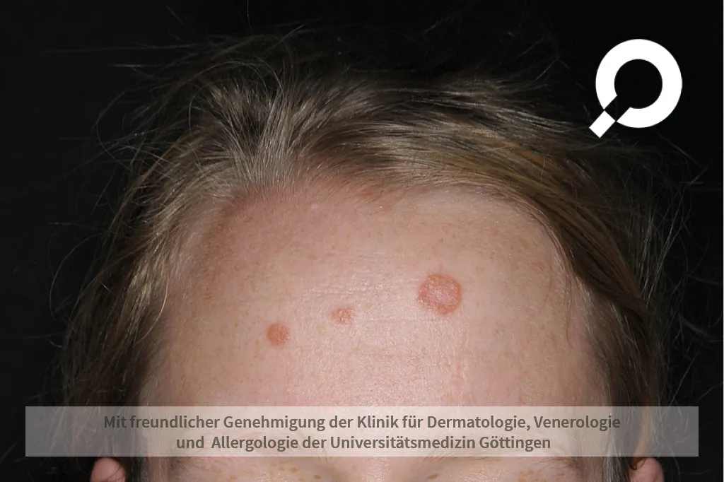 rote runde Hautflecken