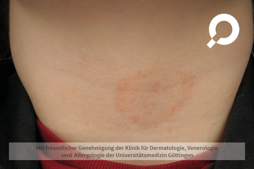 rote schuppende Hautflecke