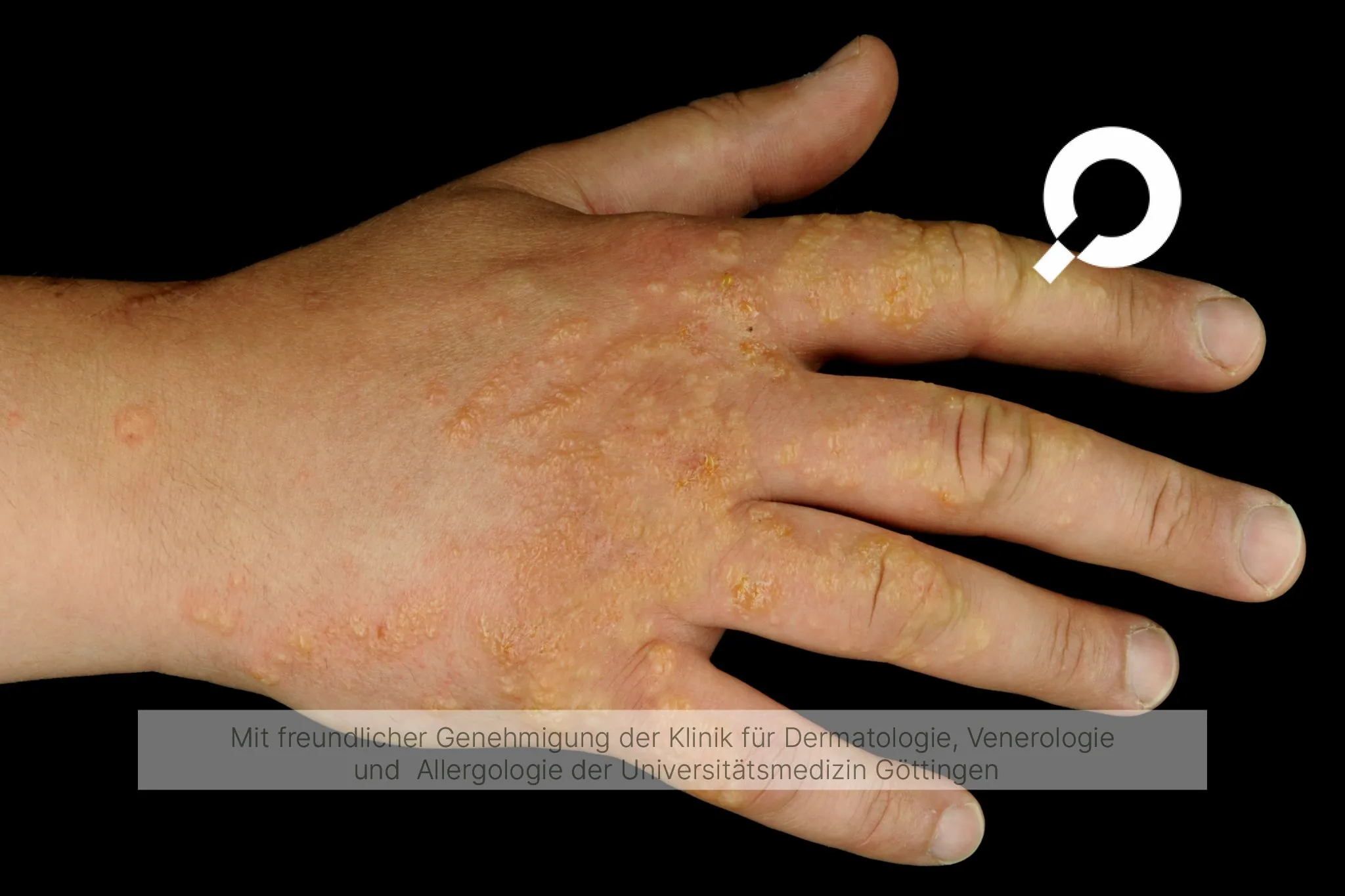 Hautausschlag an der Hand